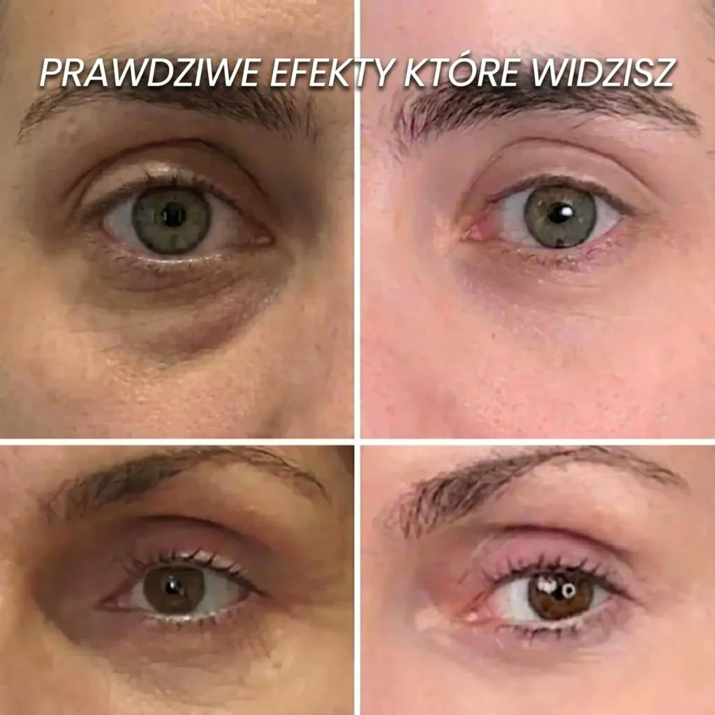 Zbliżenie na okolice oczu przed i po 30 dniach stosowania