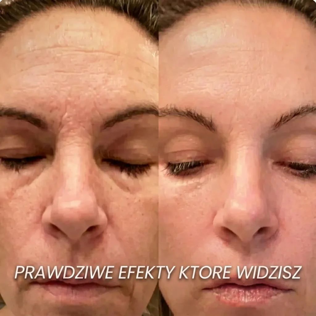Efekt przed i po — okolice oczu i czoło